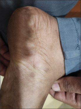 Relapse of secondary syphilis in a PLHIV - A new entity.