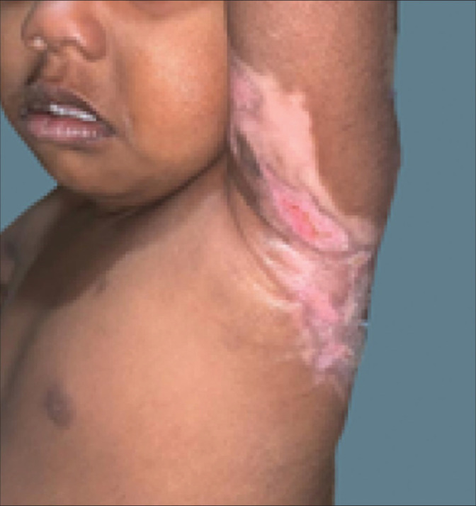 Role of topical application of Aloe Vera for accelerated wound healing of cutaneous burns Wound: A case report.