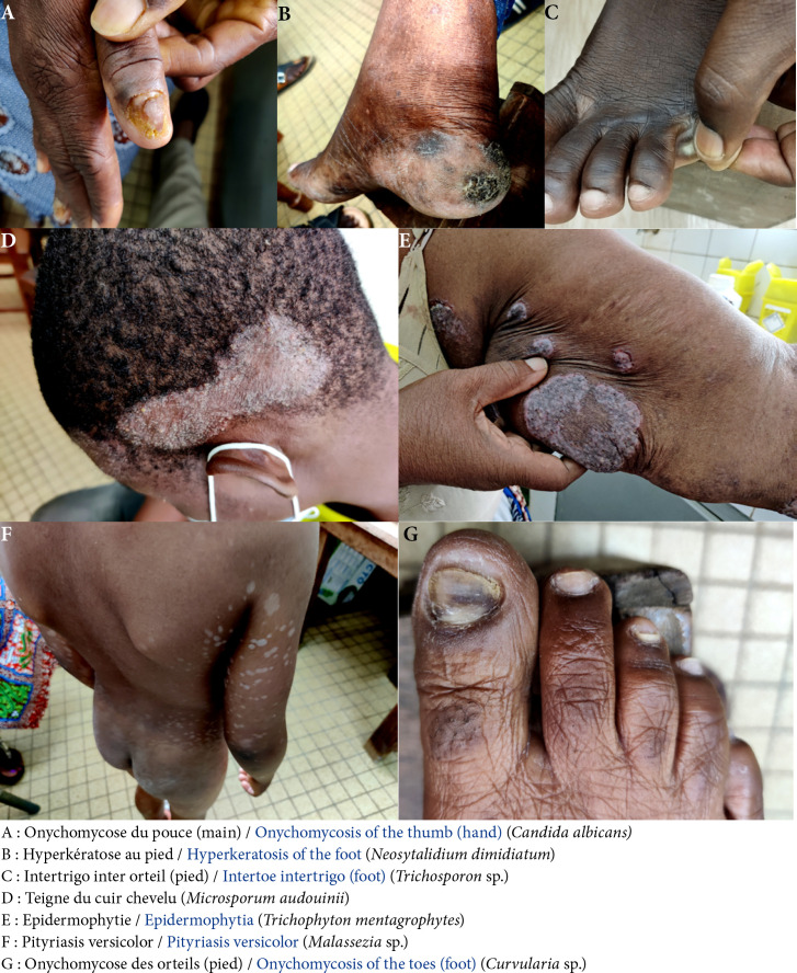 [Profile of fungal species involved in superficial cutaneous mycoses in Lomé (Togo)].