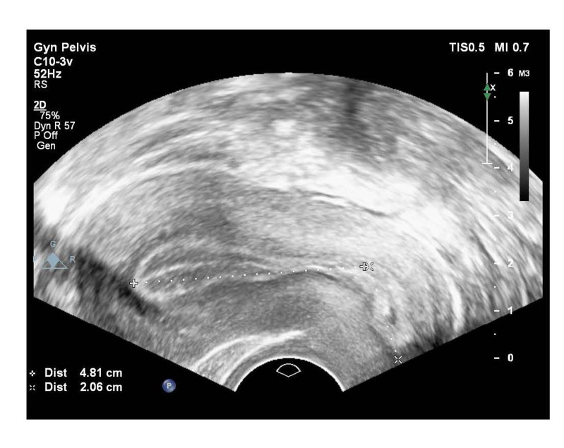 The Effect of Uterine Length Measurement before Embryo Transfer versus Transabdominal Ultrasound-Guided Embryo Transfer on FET Cycle Outcome: A Randomised Clinical Trial.
