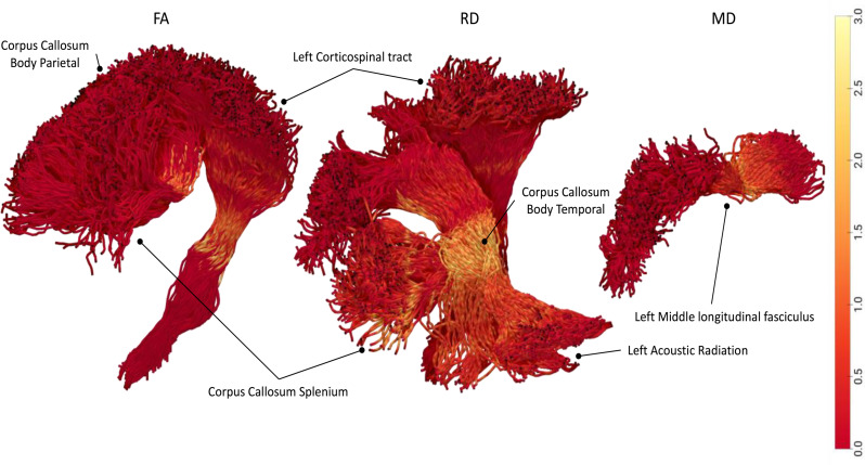 Diffusion indices alteration in major white matter tracts of children with tic disorder using TRACULA.