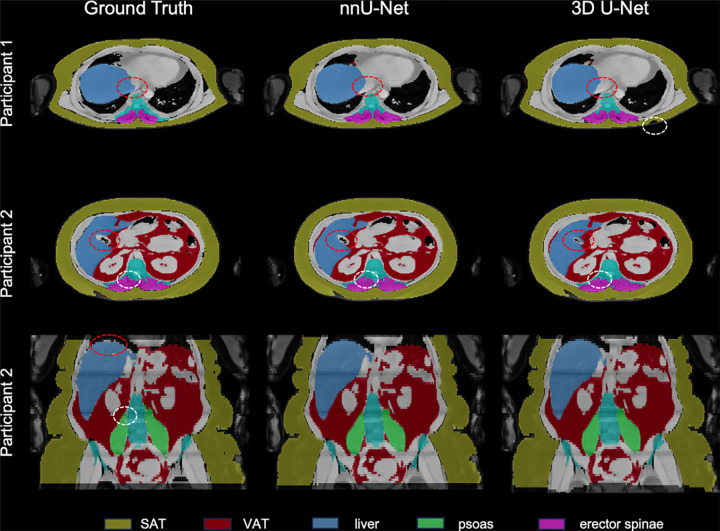 Evaluating Sex-specific Differences in Abdominal Fat Volume and Proton Density Fat Fraction at MRI Using Automated nnU-Net-based Segmentation.