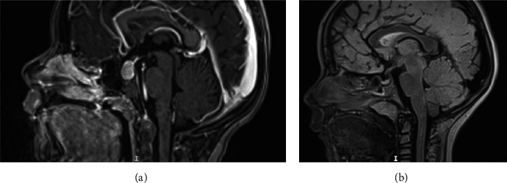 Severe Acquired Hypothyroidism and Van Wyk-Grumbach Syndrome in Two Children.