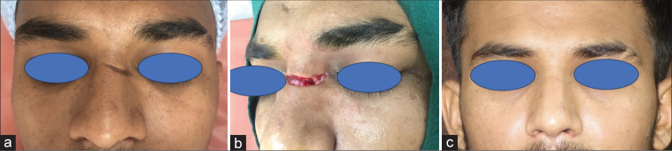 Elliptical excision and primary closure of nasal defect to achieve best esthetic outcome: A case series of 50 patients.
