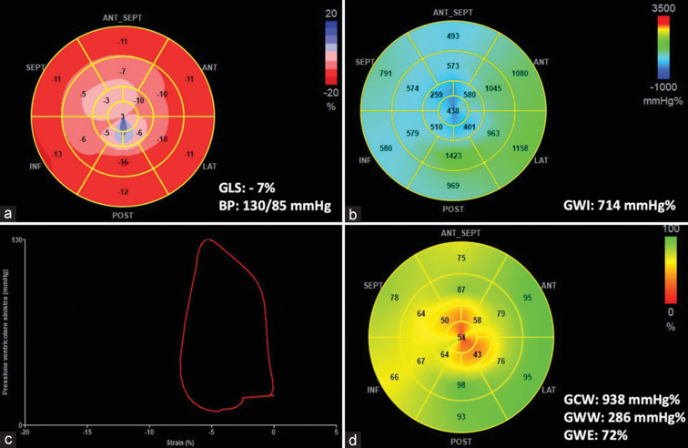 Clinical Applications of Myocardial Work in Echocardiography: A Comprehensive Review.
