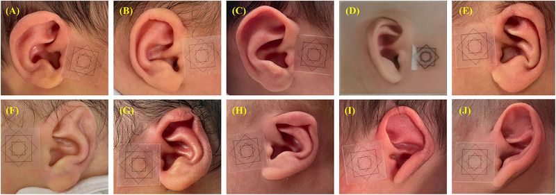 Investigation of morphometric features of auricle in newborns and etiology of auricle deformity.