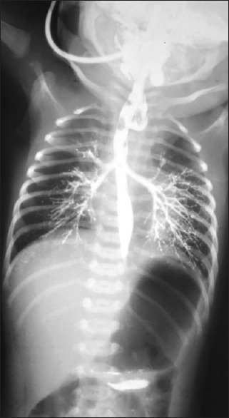 Inadvertently Displayed Trajectory of Type C Oesophageal Atresia during a Contrast Study.
