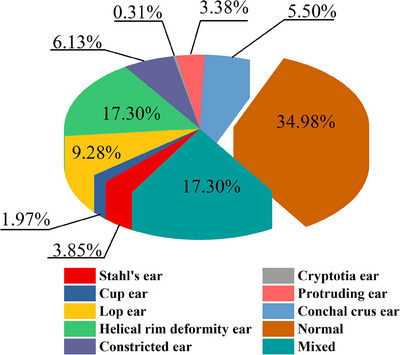 Investigation of morphometric features of auricle in newborns and etiology of auricle deformity.
