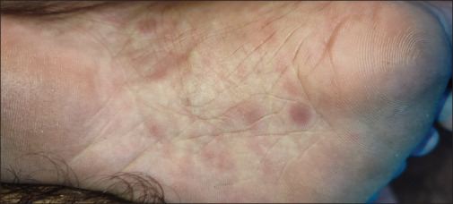 Relapse of secondary syphilis in a PLHIV - A new entity.