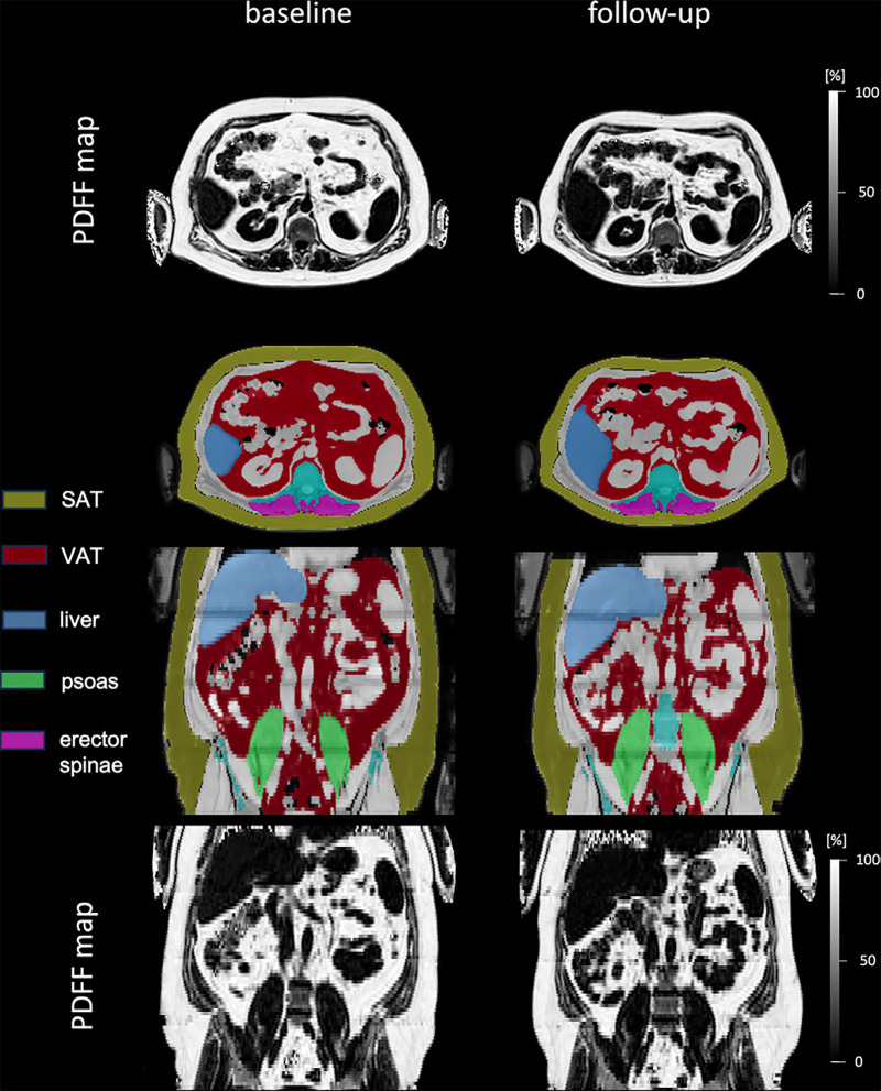 Evaluating Sex-specific Differences in Abdominal Fat Volume and Proton Density Fat Fraction at MRI Using Automated nnU-Net-based Segmentation.