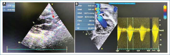 Management of supravalvular aortic stenosis with the Doty technique, in a South American pediatric center.