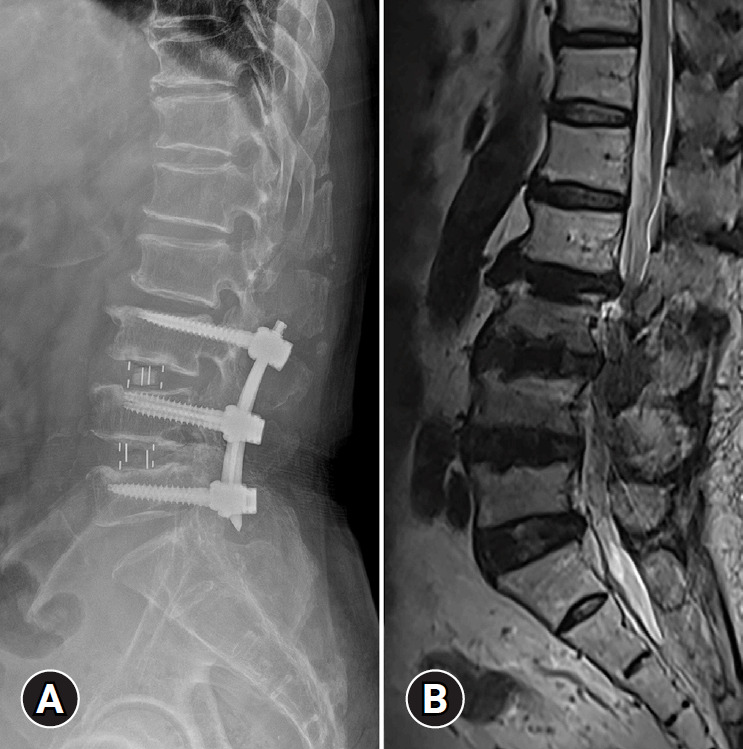 Failed back surgery syndrome-terminology, etiology, prevention, evaluation, and management: a narrative review.