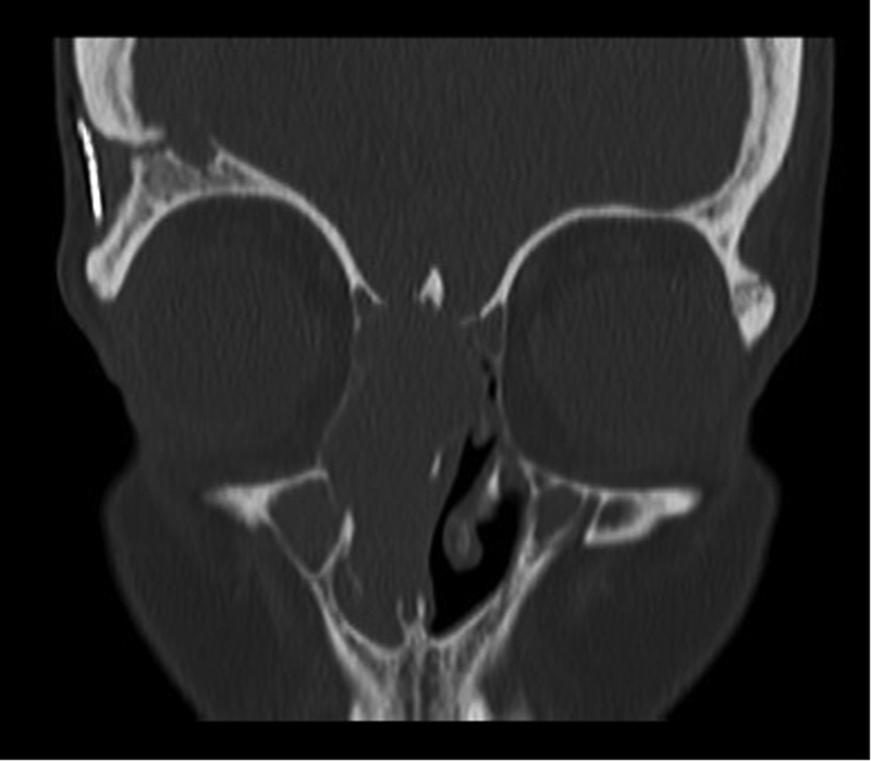 Sinonasal Malignancy Following Cranial Irradiation: A Scoping Review and Case Report of Sinonasal Teratocarcinosarcoma.