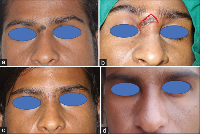 Elliptical excision and primary closure of nasal defect to achieve best esthetic outcome: A case series of 50 patients.