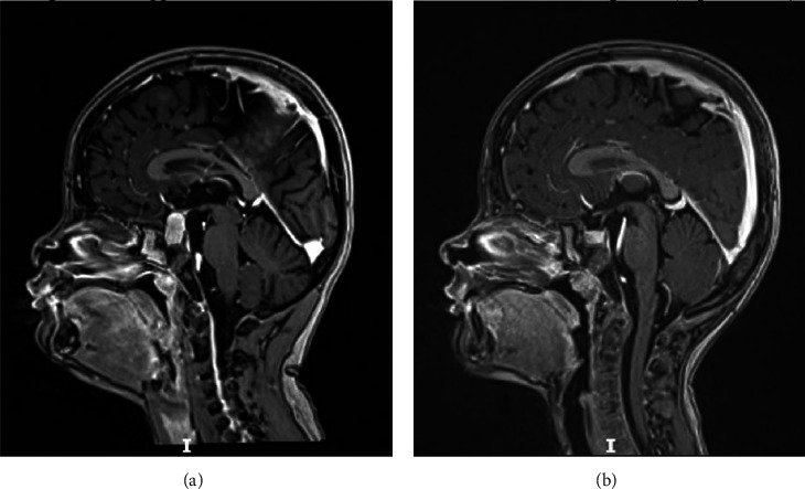 Severe Acquired Hypothyroidism and Van Wyk-Grumbach Syndrome in Two Children.