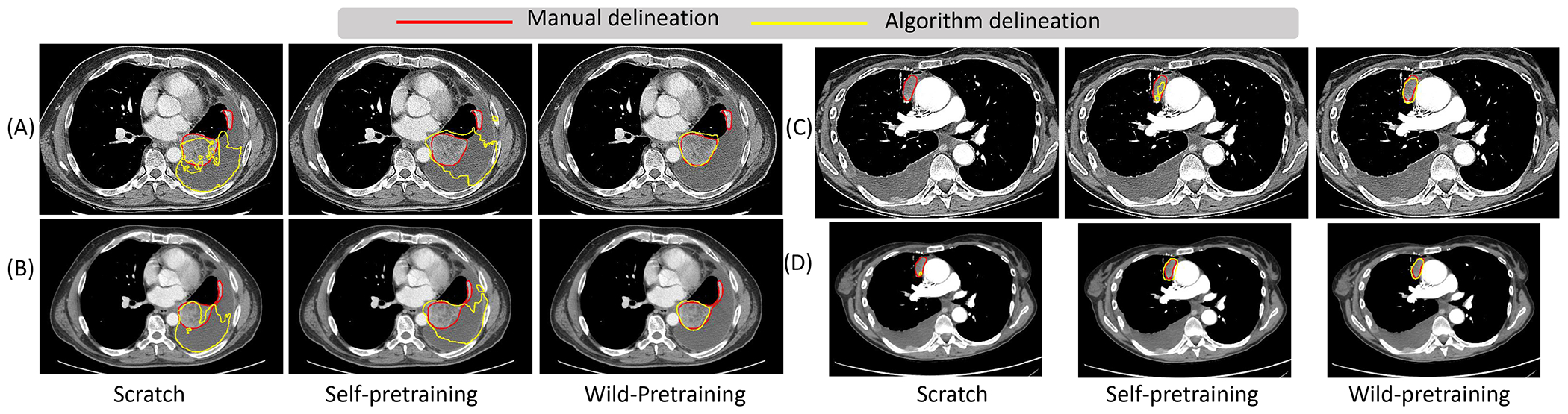 Self-supervised pretraining in the wild imparts image acquisition robustness to medical image transformers: an application to lung cancer segmentation.