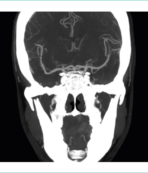 [Reversible cerebral vasoconstriction syndrome. Recurrence of thunderclap headaches after treatment with corticosteroids].