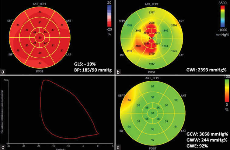 Clinical Applications of Myocardial Work in Echocardiography: A Comprehensive Review.