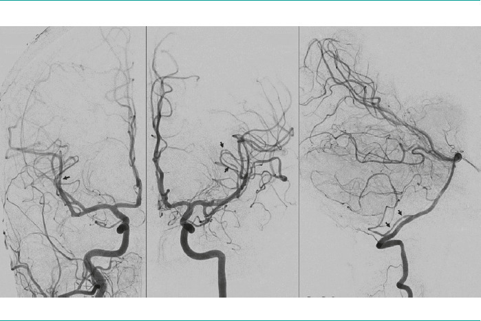 [Reversible cerebral vasoconstriction syndrome. Recurrence of thunderclap headaches after treatment with corticosteroids].