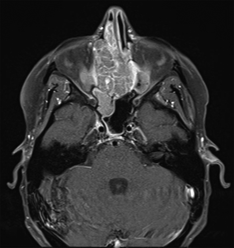 Sinonasal Malignancy Following Cranial Irradiation: A Scoping Review and Case Report of Sinonasal Teratocarcinosarcoma.