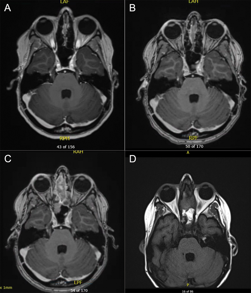 Sinonasal Malignancy Following Cranial Irradiation: A Scoping Review and Case Report of Sinonasal Teratocarcinosarcoma.