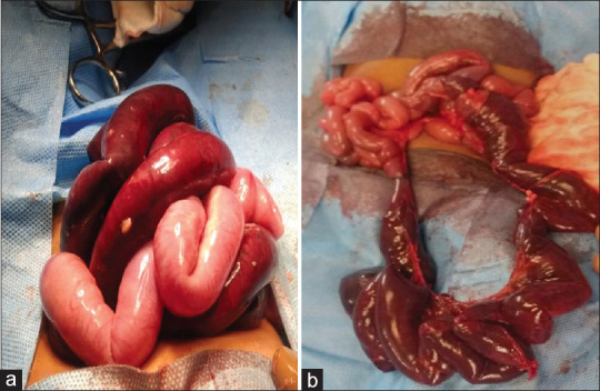 Congenital Mesenteric Defect with Transmesenteric Hernia in Children: A Case Series.