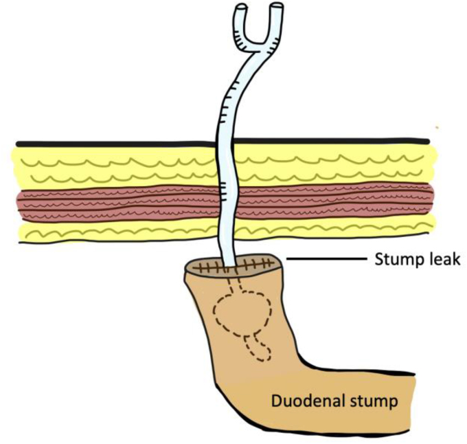 A Foley catheter 'the jack of all trades': a literature review of its common and novel uses.