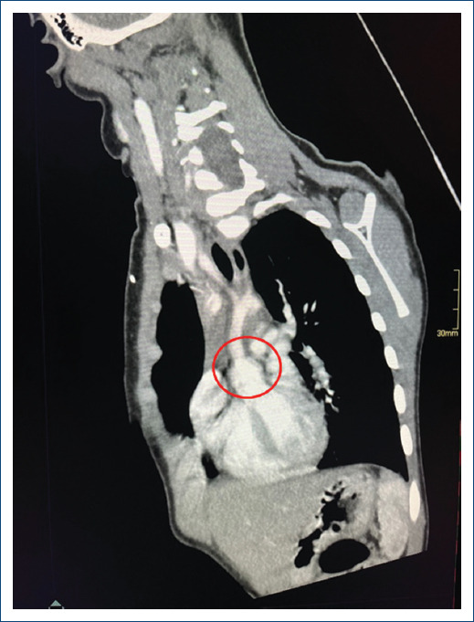 Management of supravalvular aortic stenosis with the Doty technique, in a South American pediatric center.