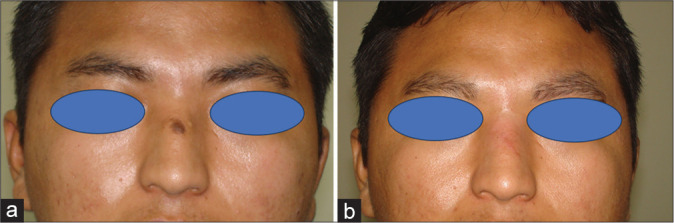 Elliptical excision and primary closure of nasal defect to achieve best esthetic outcome: A case series of 50 patients.