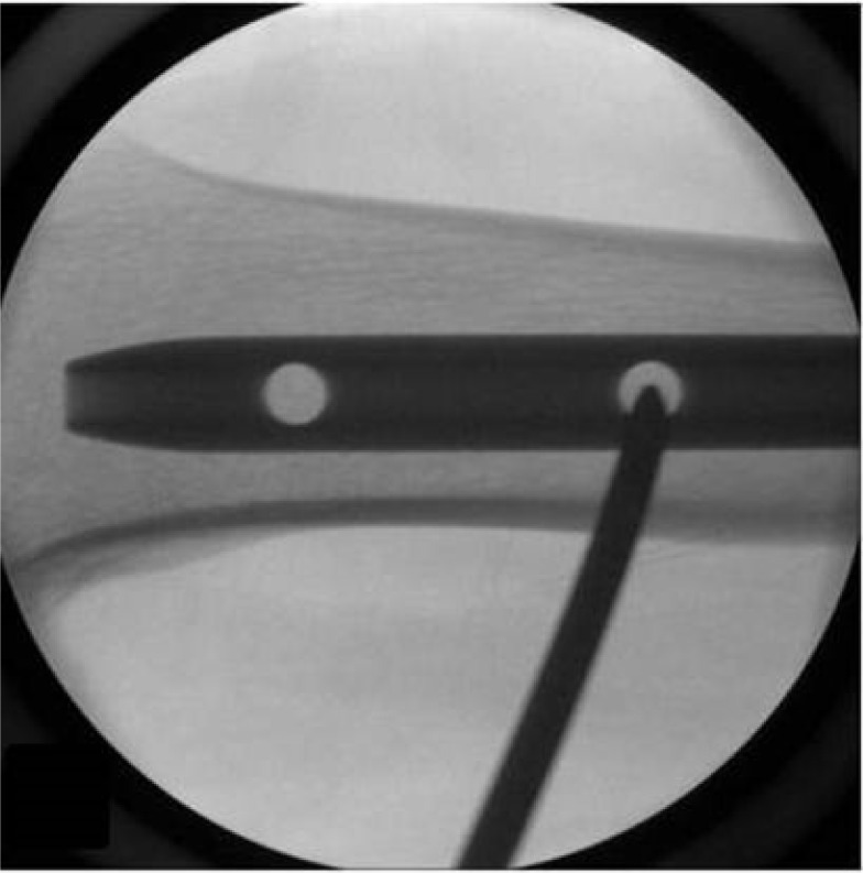 Straightforward, safe, and efficient interlocking screw insertion during intramedullary nailing using a Steinmann pin and hammer: a comparative study.