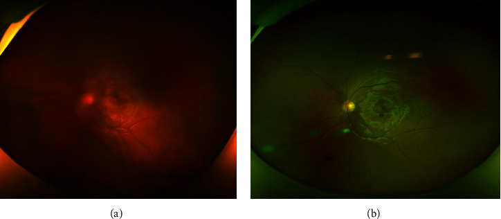 Intravitreal Dexamethasone Implant (Ozurdex) for Ocular Toxocariasis.