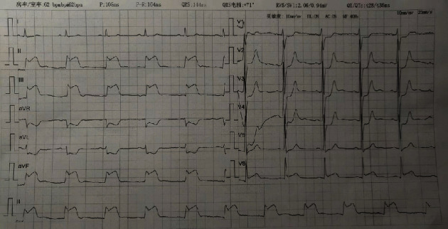 Warning Function of Frank's Sign in Pre-Existing Cardiac Disease Patients: A Case Report.