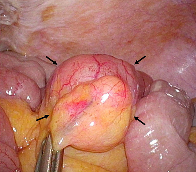 Small Bowel Bleeding Caused by a Small Bowel Lipoma in a Patient with Hemodialysis.