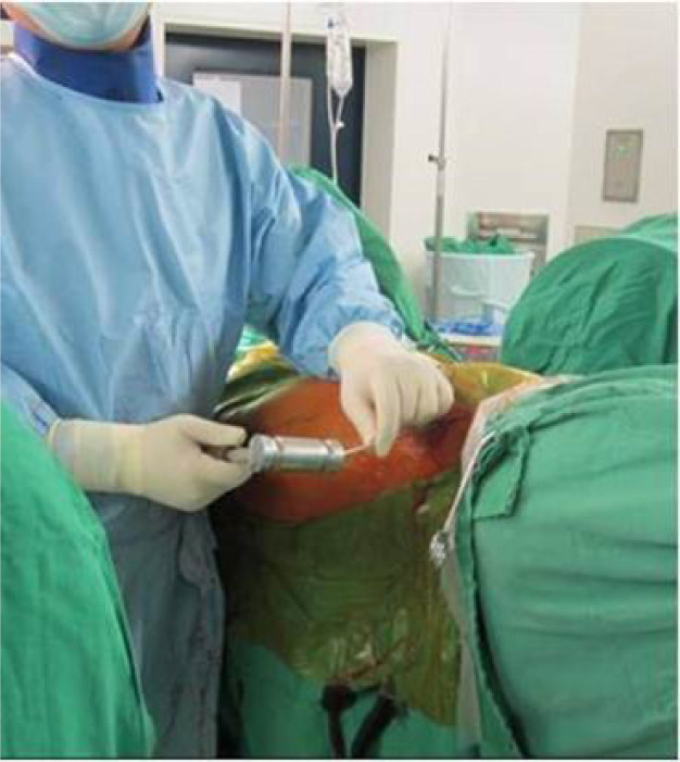 Straightforward, safe, and efficient interlocking screw insertion during intramedullary nailing using a Steinmann pin and hammer: a comparative study.