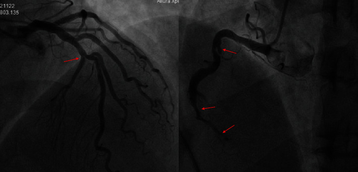 Warning Function of Frank's Sign in Pre-Existing Cardiac Disease Patients: A Case Report.