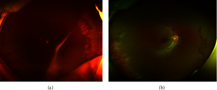 Intravitreal Dexamethasone Implant (Ozurdex) for Ocular Toxocariasis.
