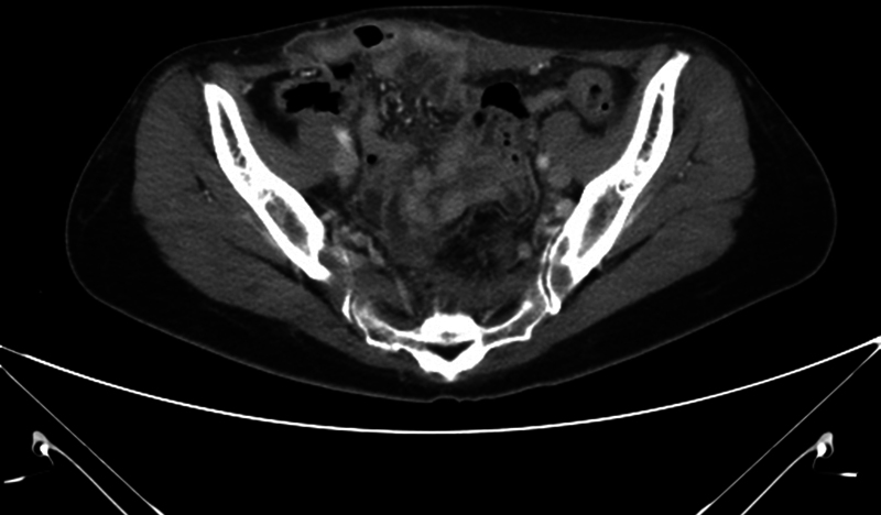 Abdominal Wall Hernias Following High-intensity Focused Ultrasound Therapy: Three Case Reports.