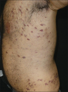 Kaposi's sarcoma immune reconstitution inflammatory syndrome: A forgotten entity nowadays.