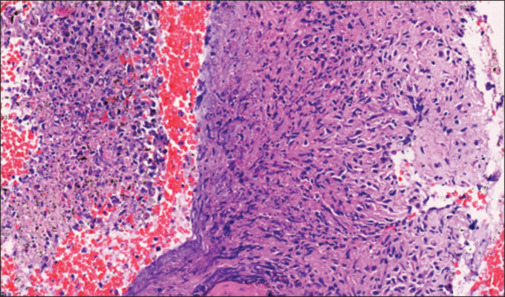 Kaposi's sarcoma unmasked by corticosteroids in an advanced HIV patient with tuberculosis immune reconstitution inflammatory syndrome.