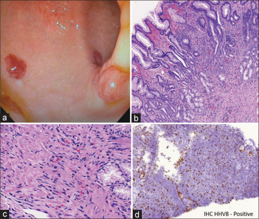 Kaposi's sarcoma unmasked by corticosteroids in an advanced HIV patient with tuberculosis immune reconstitution inflammatory syndrome.