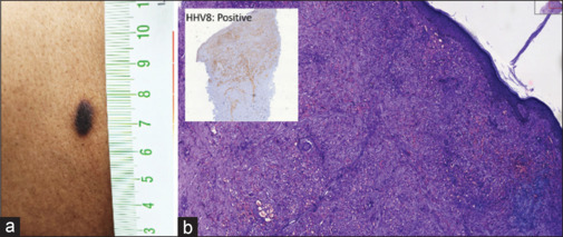 Kaposi's sarcoma unmasked by corticosteroids in an advanced HIV patient with tuberculosis immune reconstitution inflammatory syndrome.