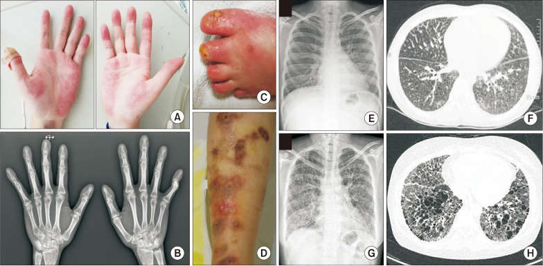 Unraveling the diagnostic odyssey: stimulator of interferon gene-associated vasculopathy with onset in infancy in a 30-year-old female.