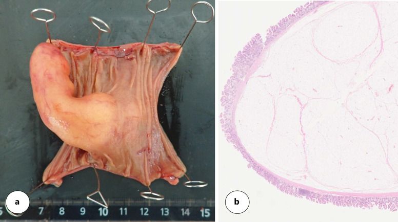 Small Bowel Bleeding Caused by a Small Bowel Lipoma in a Patient with Hemodialysis.