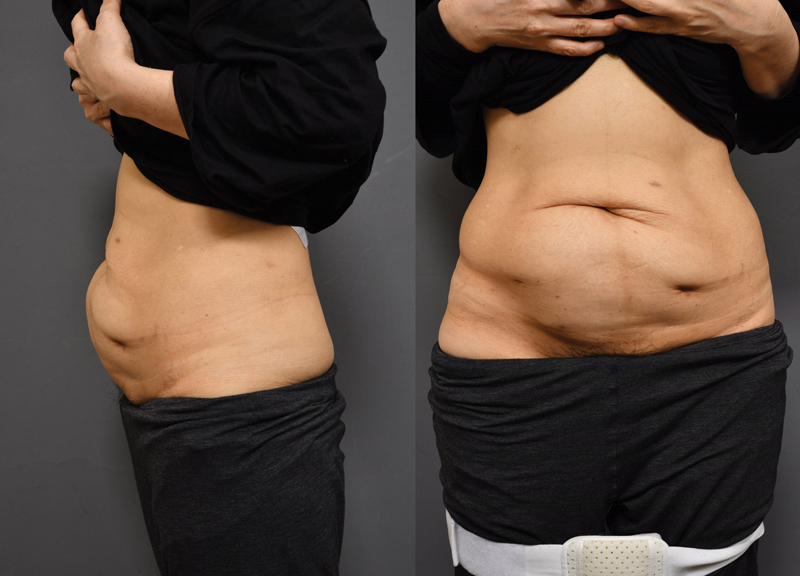 Abdominal Wall Hernias Following High-intensity Focused Ultrasound Therapy: Three Case Reports.