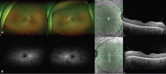 Beyond the Brain-Vogt-Koyanagi-Harada Syndrome (VKH): A Rare Brain Eye and Ear (BEE) Syndrome Presenting initially as Aseptic Meningitis- a Neurologist Perspective.