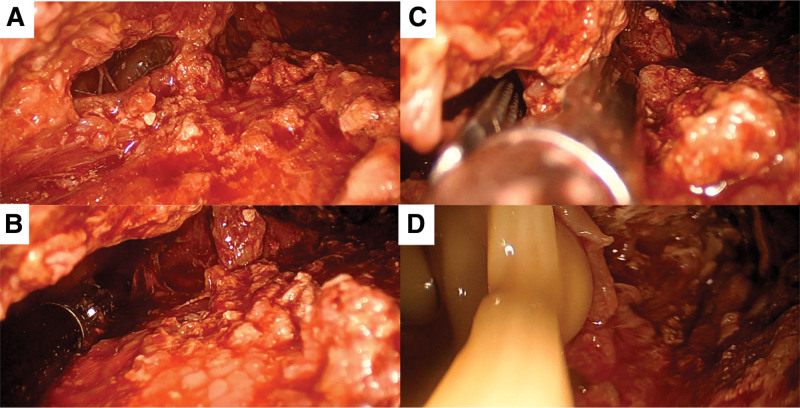 Video-assisted Retroperitoneal Debridement for Graft Pancreatitis.