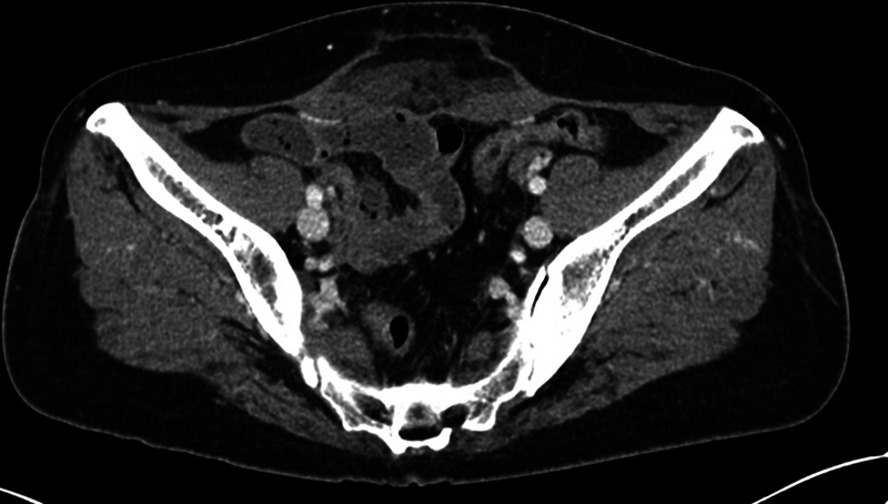 Abdominal Wall Hernias Following High-intensity Focused Ultrasound Therapy: Three Case Reports.