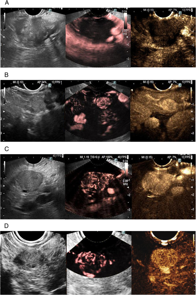 Detective flow imaging <i>versus</i> contrast-enhanced EUS in solid pancreatic lesions.