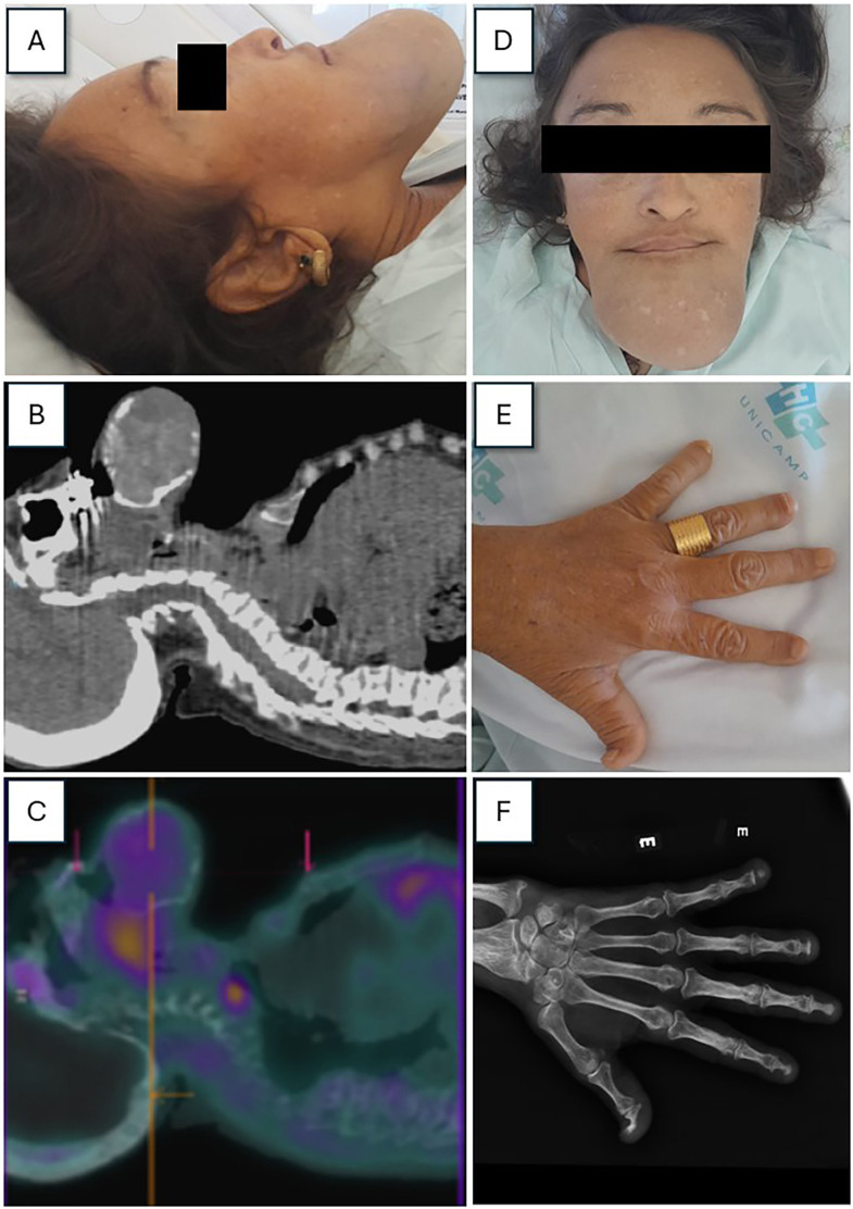 An image of a giant brown tumor due to severe secondary hyperparathyroidism.