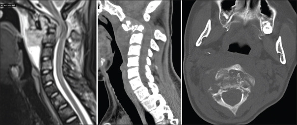 Odontoid remodeling with occipital condyle stabilization in patients with metastatic C2 involvement.